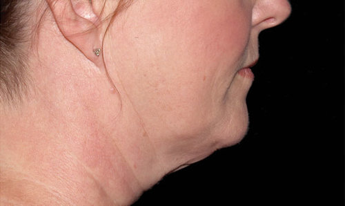 The same chin and jawline after CoolSculpting treatment, profile view, with a more defined contour