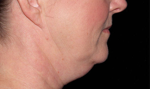 A third patient's chin and jawline before CoolSculpting treatment, profile view