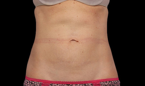 The same abdomen after CoolSculpting treatment, front view, with a flatter contour