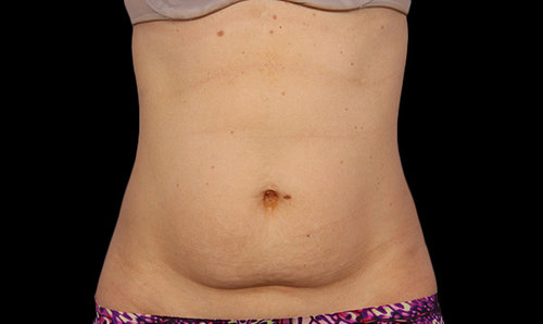 Abdomen before CoolSculpting treatment, front view