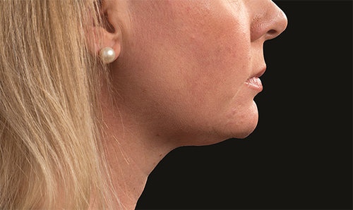 The same chin and jawline after CoolSculpting treatment, profile view, with a more defined contour