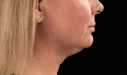 Chin and jawline before CoolSculpting treatment, profile view
