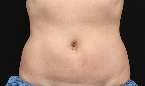 The same abdomen after CoolSculpting treatment, front view, with a flatter contour