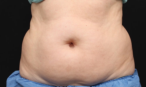 A second patient's abdomen before CoolSculpting treatment, front view