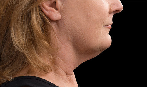 The same chin and jawline after CoolSculpting treatment, profile view, with a more defined contour