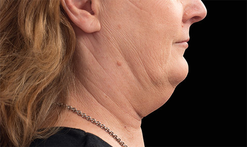 A second patient's chin and jawline before CoolSculpting treatment, profile view
