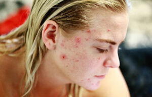 How Do I Get Rid Of Acne Scars